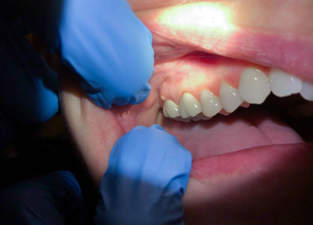 Best Emergency Treatment for Dental Infections or Abscesses in Lake Placid, FL
